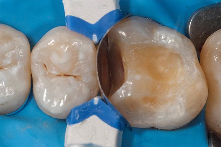 Wypełnianie ubytków w drewnie – praktyczne porady, które musisz znać